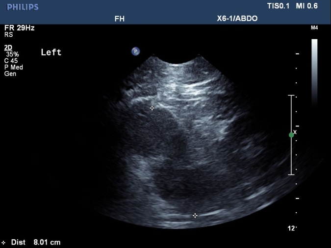 adrenal metastasis sagittal view